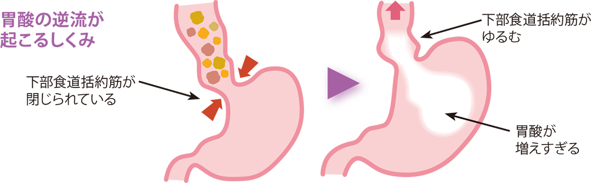 イラスト：胃食道逆流症（逆流性食道炎）